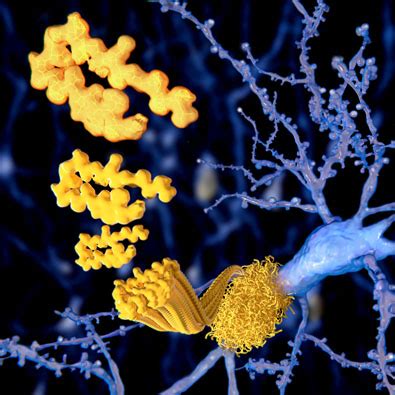 Amyloid structure linked to different types of Alzheimer’s disease.